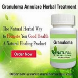 Utilize Natural Remedies to abolish Granuloma Annulare Skin Disease