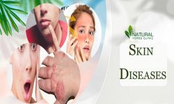 Helpful Tips to Stay Away From Skin Diseases