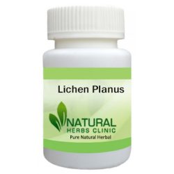 Herbal Supplements for Lichen Planus