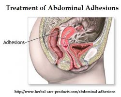 Diagnosis and Treatment of Abdominal Adhesions