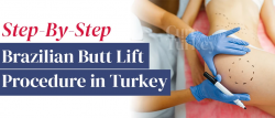 Why Choose a Brazilian Butt Lift in Turkey?