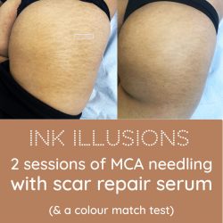 Can MCA Microneedling Help Reduce Stretch Marks?