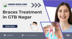 Braces Treatment in GTB Nagar – Advance Dental Clinic