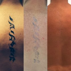 Best Laser Tattoo Removal in London – Ink Illusion