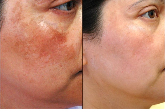 Skin Tag Removal Treatment – Safe and Quick at London Dermatology Clinics
