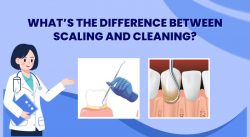 Difference between Scaling and Cleaning – Advance Dental Clinic