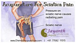 Acupuncture Treatment for Sciatica in Chennai – Jayanth Acupuncture Anna Nagar and Chetpet