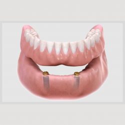 Snap on Dentures Pros, Cons & Why They’re Popular