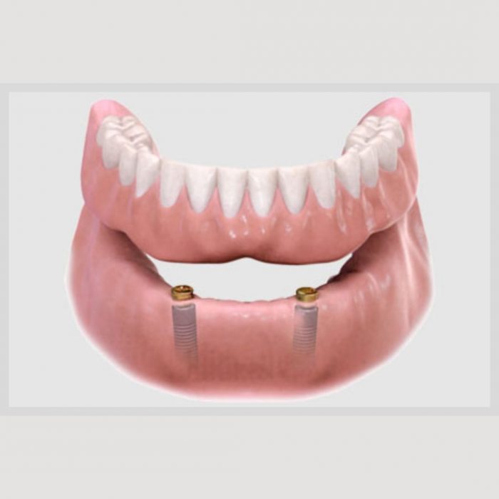 Snap on Dentures Pros, Cons & Why They’re Popular