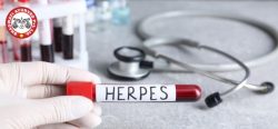 Herpes Simplex Treatment in Telangana – Bhagwati Ayurved
