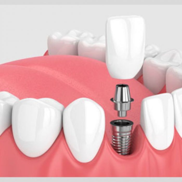 Top Rated Dental Implant Centers Near You
