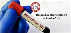 Herpes Simplex Treatment in South Africa – Bhagwati Ayurved