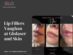 Lip Fillers Vaughan at Glolaser and Skin